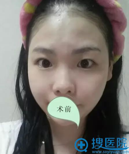手术前的塌鼻子和单眼皮 手术前的塌鼻子和单眼皮
