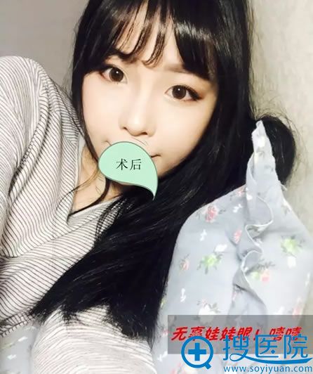 济宁韩美眼鼻综合整形案例 济宁韩美眼鼻综合整形案例