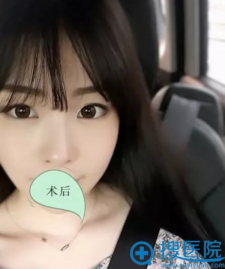 济宁韩美鼻综合案例术后效果 济宁韩美鼻综合案例术后效果