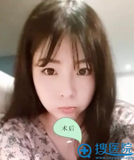 济宁韩美自体脂肪填充额头案例效果 济宁韩美自体脂肪填充额头案例效果