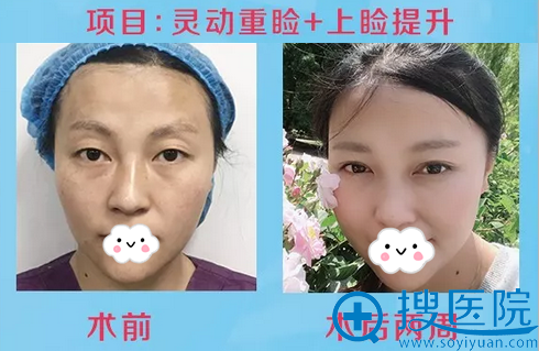 西昌爱丽诺上眼皮+上睑提升案例 西昌爱丽诺上眼皮+上睑提升案例