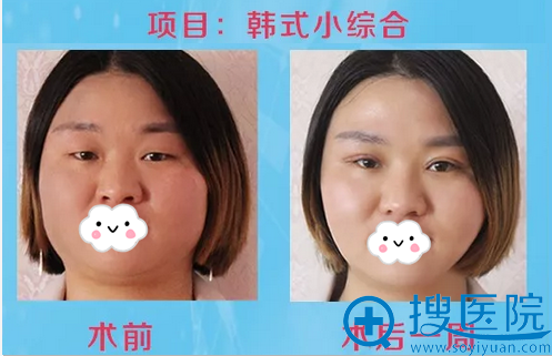 西昌爱丽诺韩式眼综合案例对比 西昌爱丽诺韩式眼综合案例对比