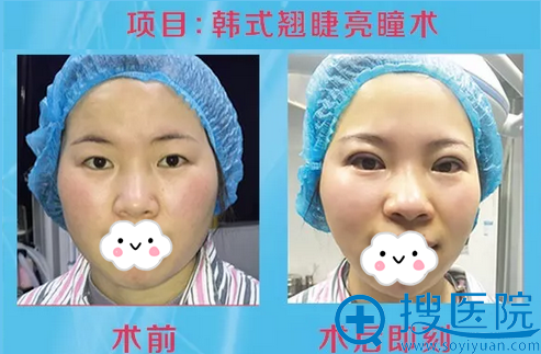 西昌艾琳韩式翘睫双眼皮术后即刻对比 西昌艾琳韩式翘睫双眼皮术后即刻对比
