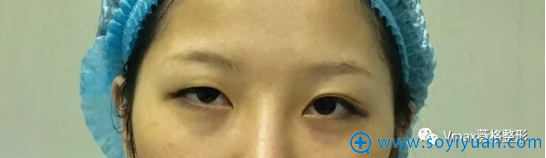 厦门薇格割双眼皮术前照 厦门薇格割双眼皮术前照