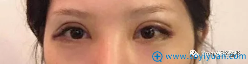 双眼皮手术后3天恢复情况 双眼皮手术后3天恢复情况