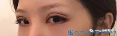 双眼皮7天拆线效果 双眼皮7天拆线效果