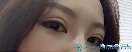 双眼皮手术半个月就美美哒 双眼皮手术半个月就美美哒