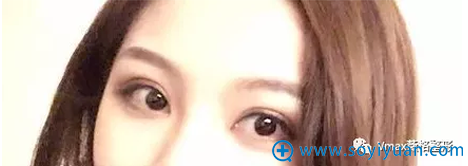 厦门薇格双眼皮手术45天恢复效果 厦门薇格双眼皮手术45天恢复效果