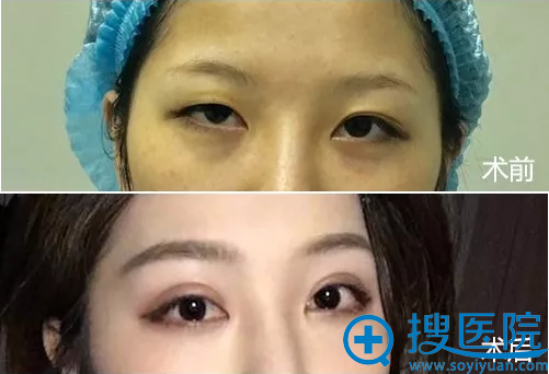 厦门薇格双眼皮手术前后对比照片 厦门薇格双眼皮手术前后对比照片
