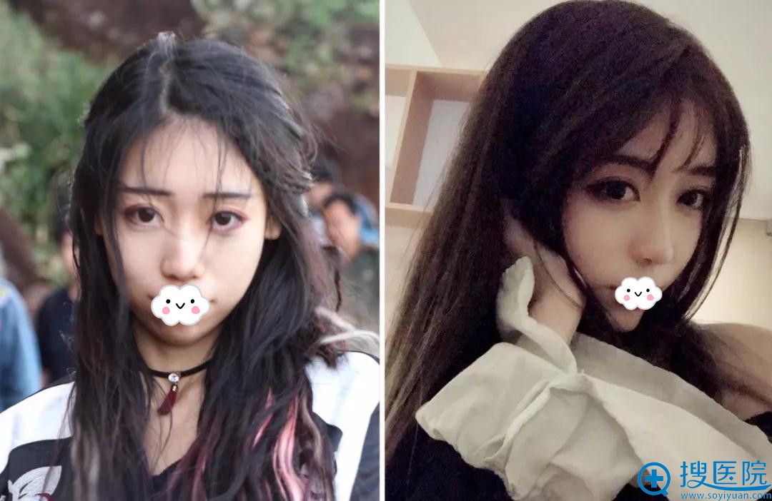哪里做整形好?看西安邵锦弘医疗美容双眼皮隆鼻瘦脸案例及价格