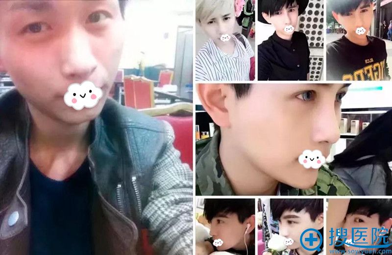 在<!--<i data=20240710 data-id=13945></i>-->医疗美容做微整形效果对比 在<!--<i data=20240710 data-id=13945></i>-->医疗美容做微整形效果对比
