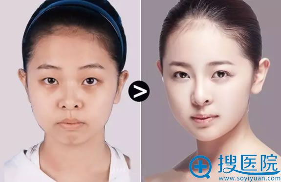 眼鼻整形医生聂波的双眼皮和隆鼻案例 眼鼻整形医生聂波的双眼皮和隆鼻案例