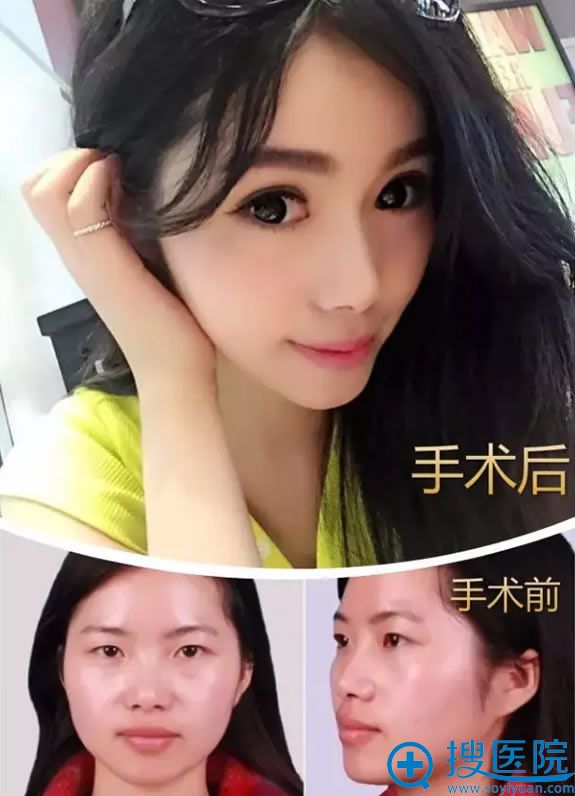 聂波医生做眼鼻综合整形案例图 聂波医生做眼鼻综合整形案例图