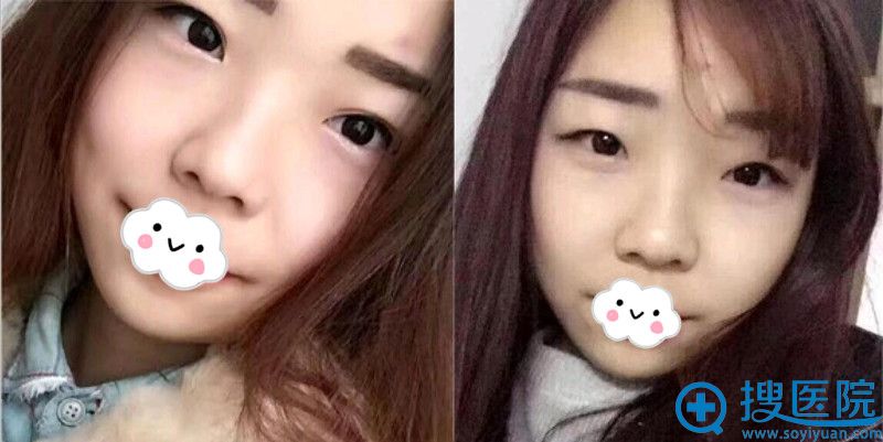 闺蜜鼓励我到武汉美莱让卓田做了双眼皮+开眼角看案例效果好吗?