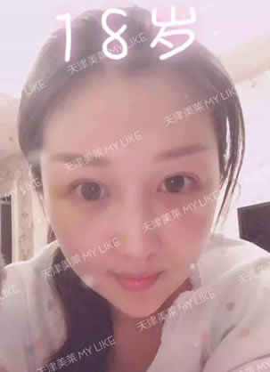 两个孩子宝妈用亲身经历告诉你美莱李战强做鼻子修复手术靠谱
