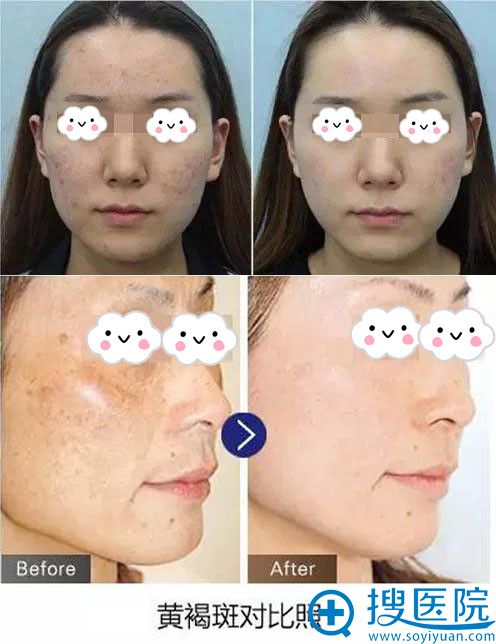 美佳娜医疗整形皮秒激光案例对比 美佳娜医疗整形皮秒激光案例对比