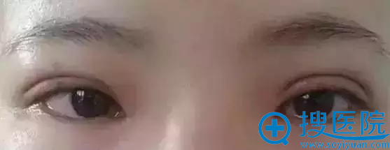 4月14日眼修复医生曹仁昌亲临吴氏嘉美 打造你想要的无痕双眼皮