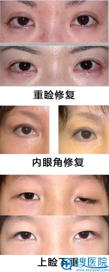 双眼皮医生曹仁昌失败修复案例 双眼皮医生曹仁昌失败修复案例