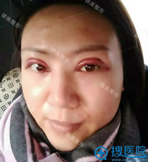 开眼角手术后第1天效果图片 开眼角手术后第1天效果图片