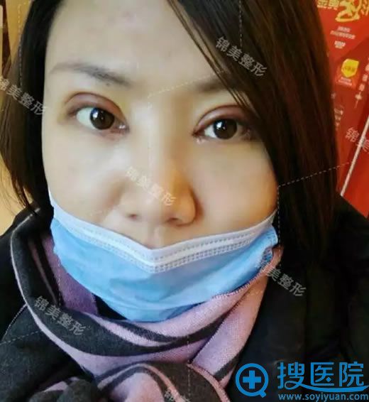锦美整形医院开眼角第2天效果 锦美整形医院开眼角第2天效果