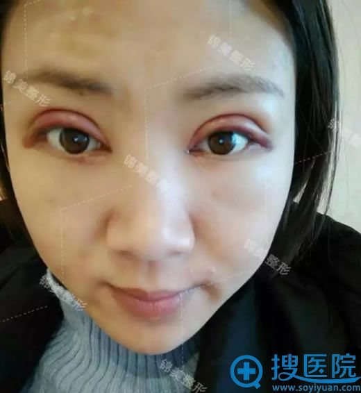锦美员工做开眼角手术第3天效果 锦美员工做开眼角手术第3天效果