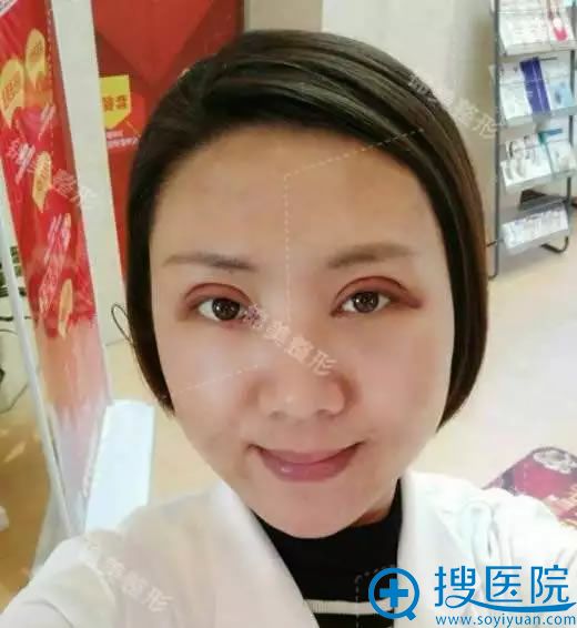 开眼角第5天工作照片 开眼角第5天工作照片