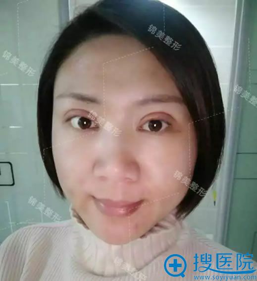 开眼角和双眼皮第7天恢复照片 开眼角和双眼皮第7天恢复照片