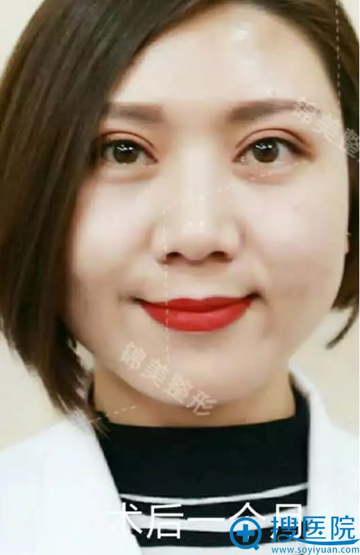 在锦美做完开眼角30天恢复图片 在锦美做完开眼角30天恢复图片