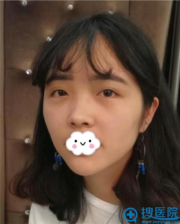 到贵阳华美做了鼻综合+面部填充 感谢谢占军将我打造出仙女范