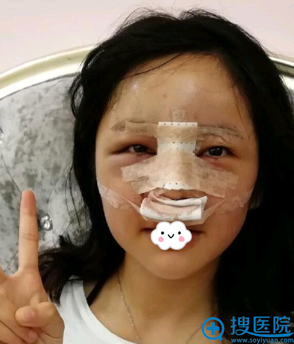 贵阳华美鼻综合+面部脂肪填充术后天 贵阳华美鼻综合+面部脂肪填充术后天