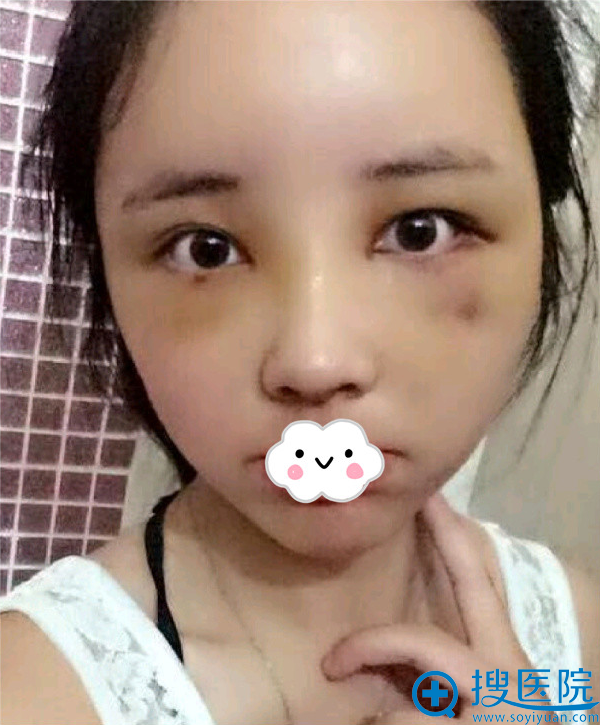 贵阳华美鼻综合+面部脂肪填充术后5天效果 贵阳华美鼻综合+面部脂肪填充术后5天效果