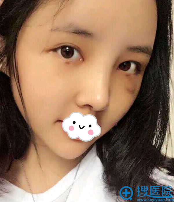 贵阳华美谢占军鼻综合术后10天 贵阳华美谢占军鼻综合术后10天