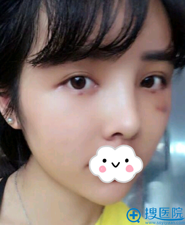 贵阳华美谢占军面部脂肪填充术后14天 贵阳华美谢占军面部脂肪填充术后14天