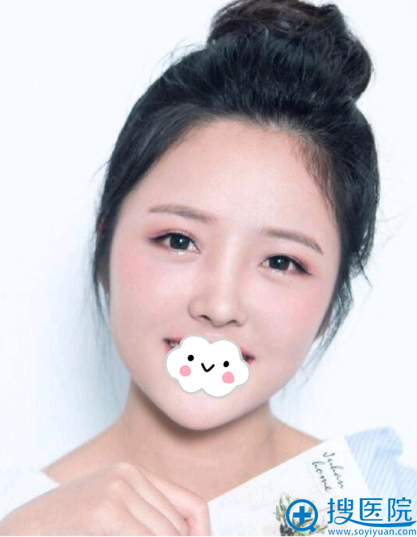 贵阳华美谢占军鼻综合+面部脂肪填充案例 贵阳华美谢占军鼻综合+面部脂肪填充案例