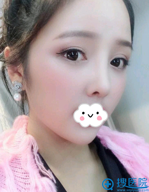 贵阳华美谢占<!--<i data=20240710 data-id=92></i>-->生隆鼻案例 贵阳华美谢占<!--<i data=20240710 data-id=92></i>-->生隆鼻案例