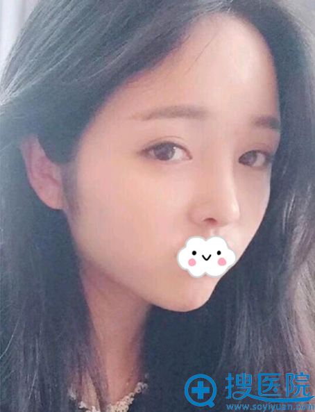 贵阳华美鼻综合+面部脂肪填充术后4个月 贵阳华美鼻综合+面部脂肪填充术后4个月