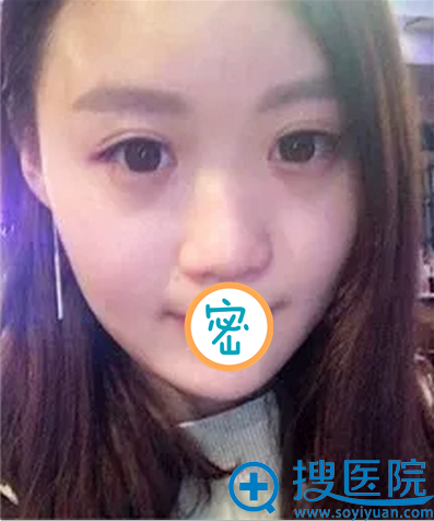 胡凯鼻整形案例分享 真人讲述在宜宾韩美做鼻综合后气质提升
