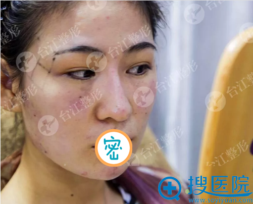 自体脂肪填充面部术后3天 自体脂肪填充面部术后3天