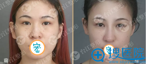 面部脂肪填充术前术后对比 面部脂肪填充术前术后对比