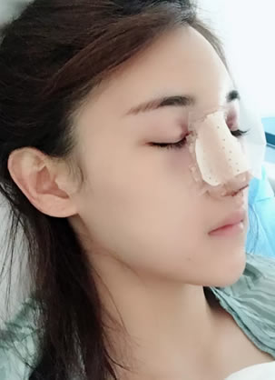 在南宁华美胡凯帮助下成功将线雕隆鼻取出换成肋软骨和膨体隆鼻