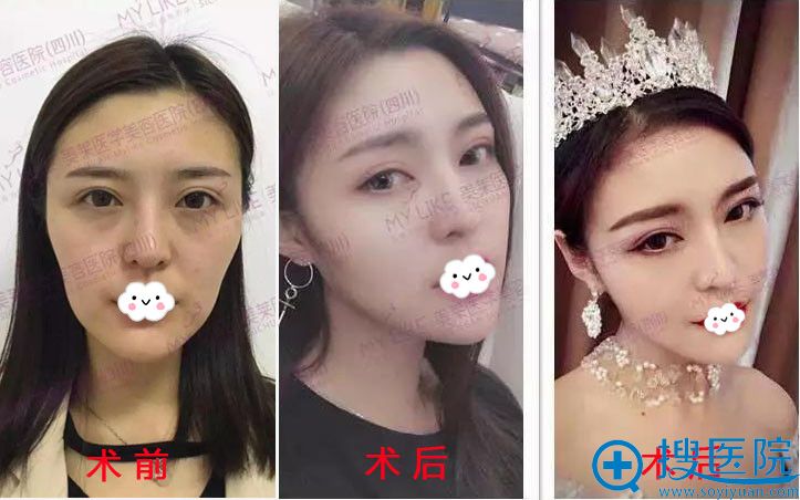 美莱艺术面雕·童颜线真人秀案例 美莱艺术面雕·童颜线真人秀案例
