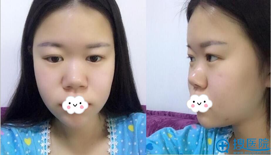 雅芳亚丁庆丰为我做假体+耳软骨隆鼻改变颜值 从此告别塌陷鼻