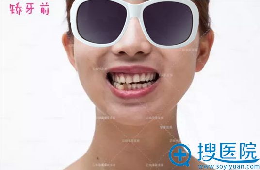 牙齿隐形矫正术前照片 牙齿隐形矫正术前照片