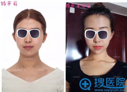 <!--<i data=20240710 data-id=5560></i>-->美莱隐适美隐形矫正对比照 <!--<i data=20240710 data-id=5560></i>-->美莱隐适美隐形矫正对比照