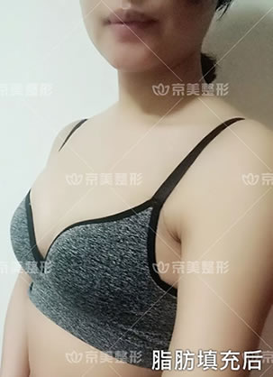 假体隆胸后8天就到北京京美做了假体取出和自体脂肪隆胸手术