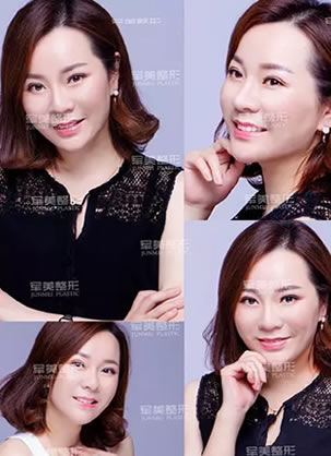看别人是如何从女人晋升女神的 重庆军美线雕祛法令纹真人案例