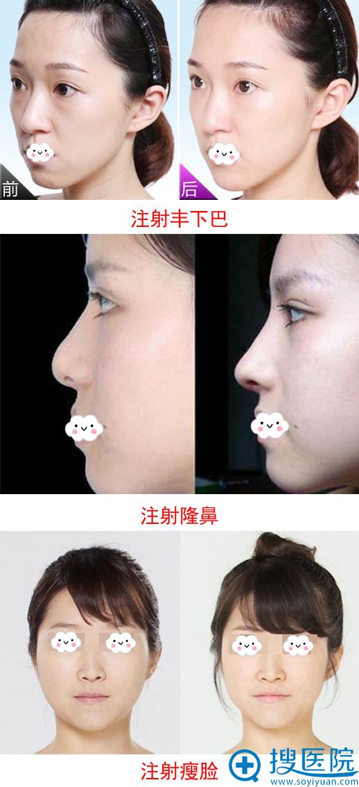 注射丰下巴、隆鼻、瘦脸案例 注射丰下巴、隆鼻、瘦脸案例