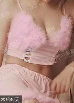 本姑娘决定公开在新星靓做抽脂肪丰胸告别小平胸的真实日记