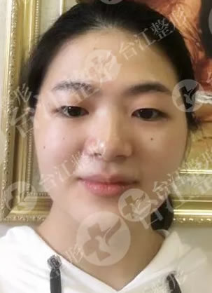 为了更好确认眼神遇见对的人 我找福州台江马美洲割双眼皮了