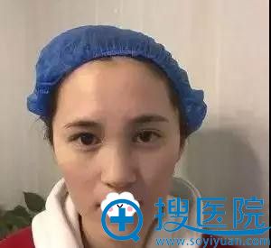 看巩义恒颜整形为我做了假体隆鼻+耳软骨垫鼻尖后打造出混血风